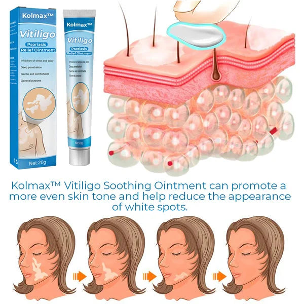 Vitiligo Soothing Ointment