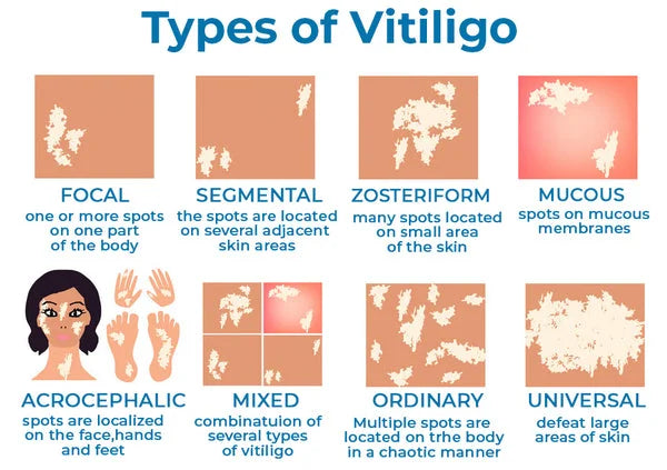 Vitiligo Soothing Ointment